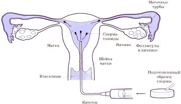 Антитела к спермальным антигенам (в сперме)