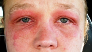 Приступ аллергии: симптомы и первая помощь